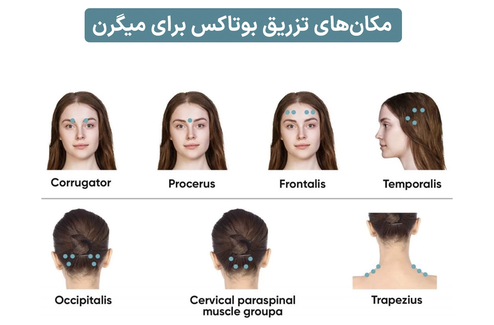 نقاط تزریق بوتاکس میگرن